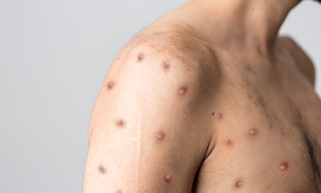 Semsa de Parauapebas nega casos de Mpox e alerta sobre fake news.
